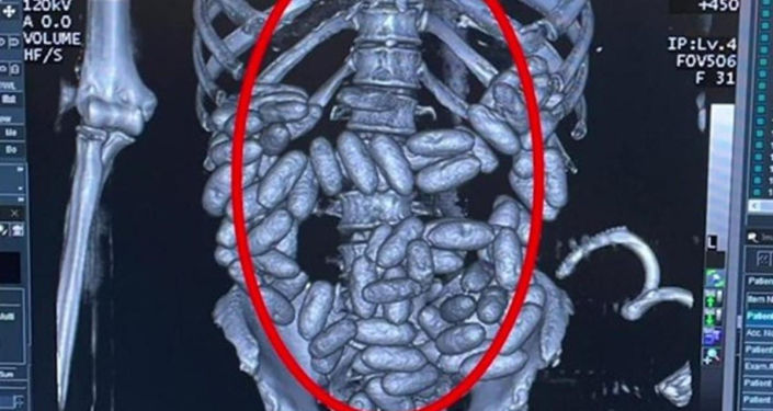 İstanbul Havalimanı’nda Nijerya uyruklu yolcunun midesinden bin 844 gram kokain çıktı